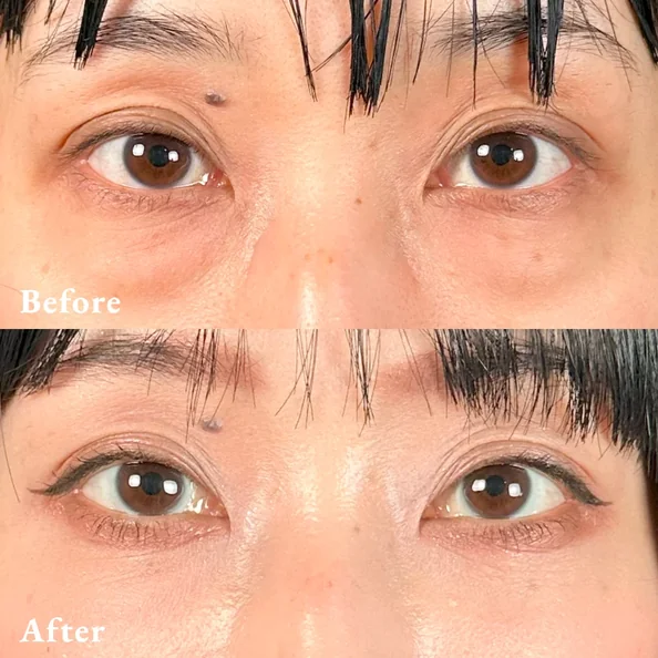 症例写真 Before/After