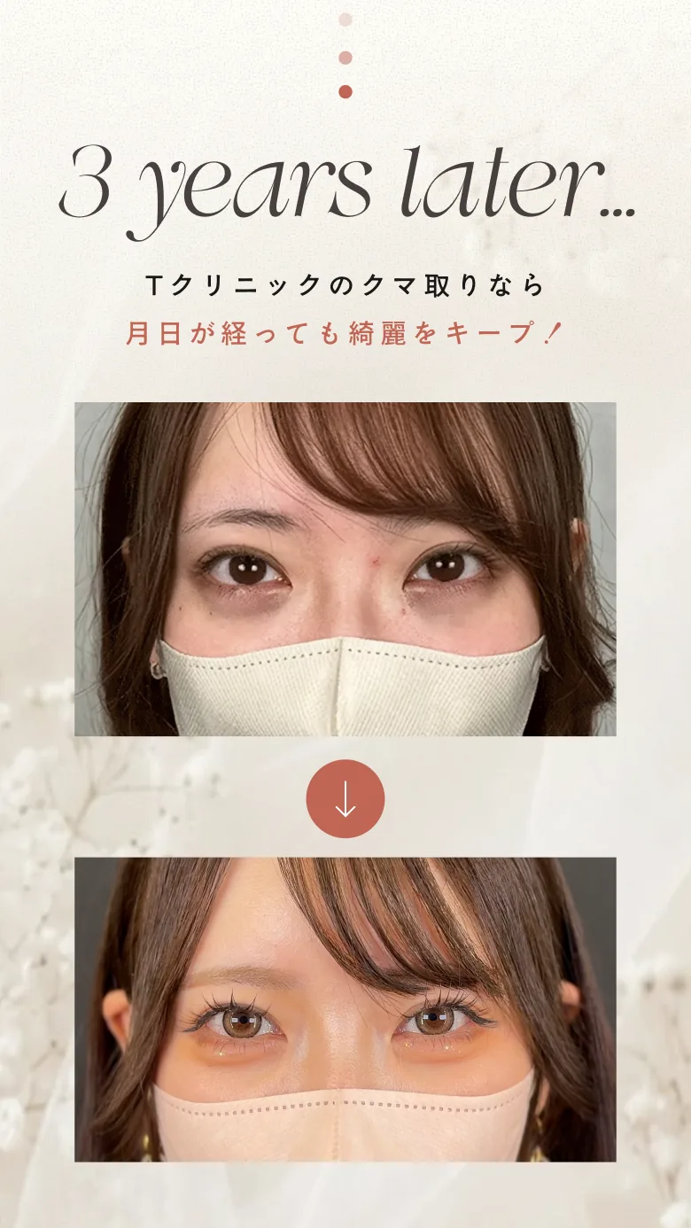 3 years later... Tクリニックのクマ取りなら月日が経っても綺麗をキープ